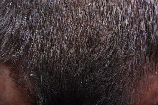 Dandruff in the hair
