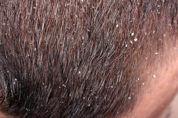 Dandruff in the hair