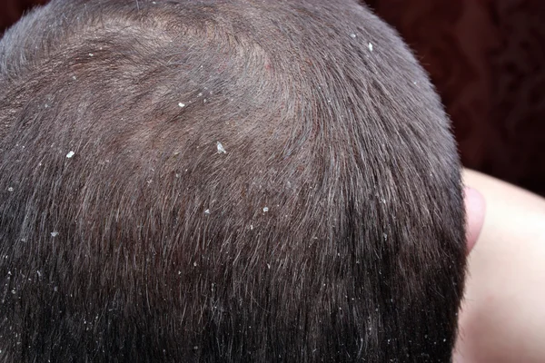 Dandruff di rambut — Stok Foto