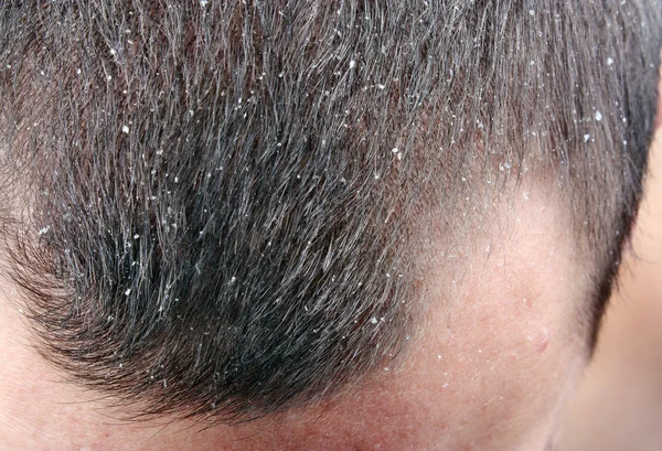 Dandruff di rambut — Stok Foto