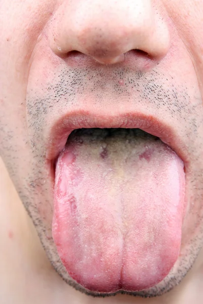 細菌感染症の病気の舌 — ストック写真