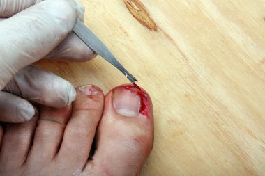 kırık kanama parmak çivi