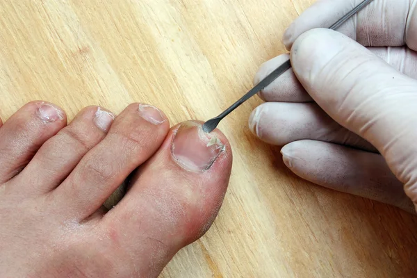 Wyrywanie złamane paznokci — Zdjęcie stockowe
