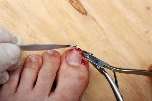 Złamane krwawienia paznokci — Zdjęcie stockowe