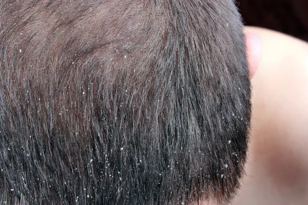 Forfora nei capelli — Foto Stock