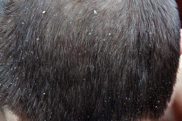 Dandruff in the hair — Stock Photo, Image