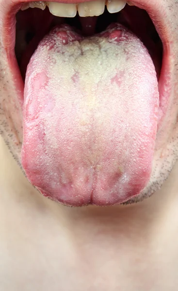 Disease  infection tongue — Stock Photo, Image