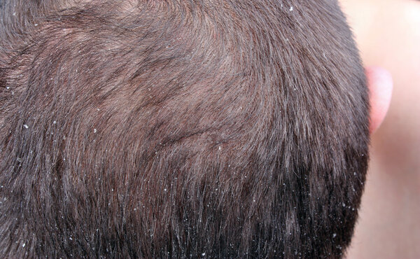 Dandruff in the hair