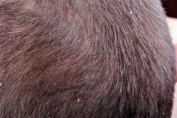 Dandruff in the hair — Stock Photo, Image