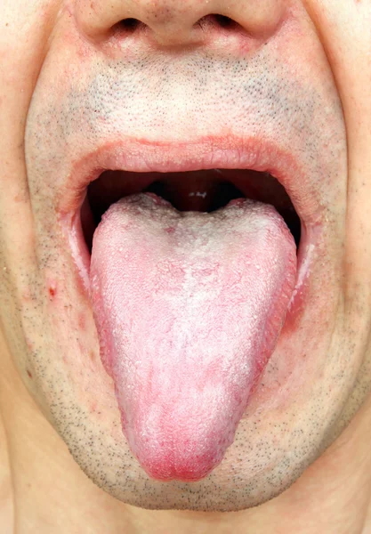 Zakażenie język — Zdjęcie stockowe