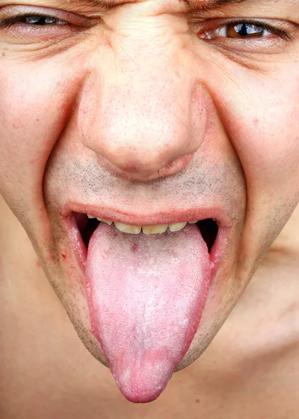 Infection tongue — Stock Photo, Image