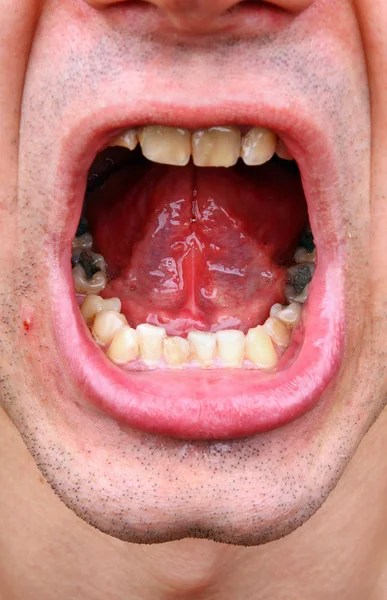 Tartar and tooth decay — Stock Photo, Image