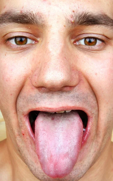 Bacterial infection disease tongue and herpes — Stock Photo, Image