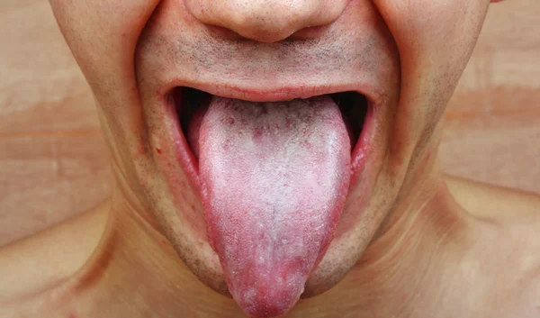 Infection tongue — Stock Photo, Image