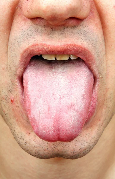Bacterial infection disease tongue — Stock Photo, Image