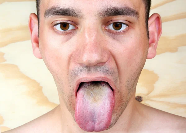 Infección lengua — Foto de Stock