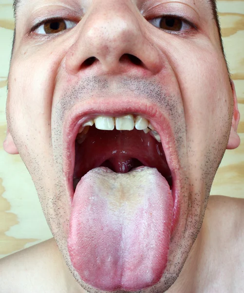 Bakterielle Infektionskrankheit Zunge lizenzfreie Stockbilder