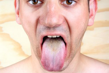 bakteriyel enfeksiyon Hastaligi dil ve herpes