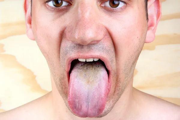 Bakterielle Infektionskrankheit Zunge und Herpes lizenzfreie Stockbilder