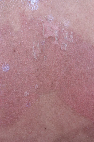 Sunburn skin — Stock Photo, Image