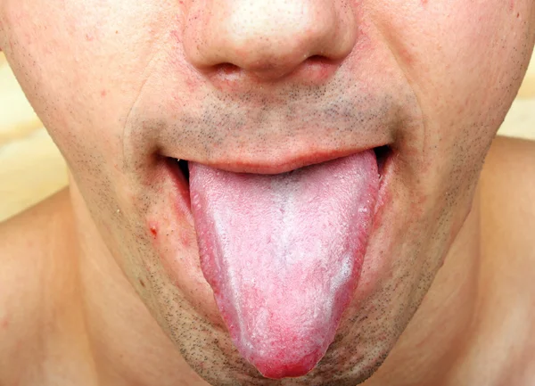 Infecção bacteriana doença língua — Fotografia de Stock