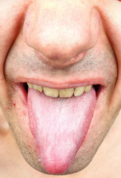 Disease tongue infection — Stock Photo, Image