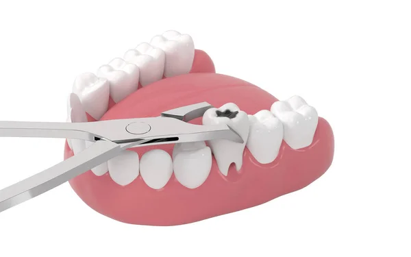 不健康な歯 3Dレンダリング コンピュータ デジタル ドローイング — ストック写真