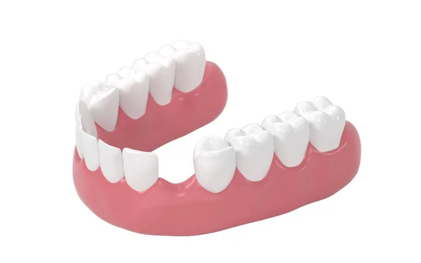 歯の欠如 歯の治療 3Dレンダリング コンピュータ デジタル ドローイング — ストック写真