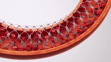 Koroner stent takılı kan damarı, 3 boyutlu..