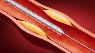 Koroner stent takılı kan damarı, 3 boyutlu..