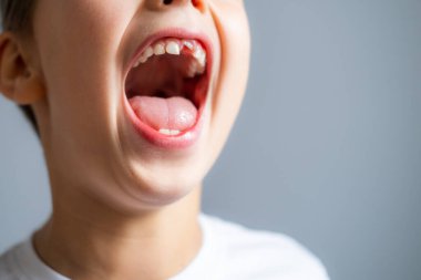 Sütsüz üst dişli, beyaz tişörtlü, gri arka planda bir çocuk. Kapat..