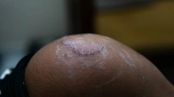 A close up view of circle ringworm with medical treatment cream is applied on the patient\'s knee cap.