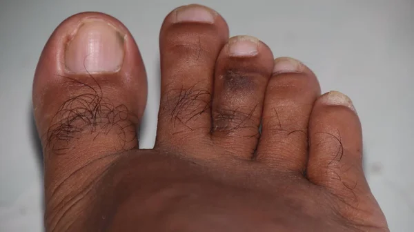 Pedicure Cosmetic Treatment Feet Toenails Analogous Manicure Pedicures Done Cosmetic — Stock Photo, Image