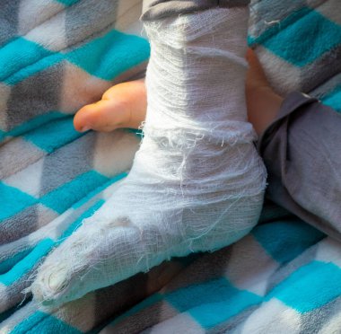 Topuk kırığında bandaj olan bir çocuk. Sağ ayağı kırık, yeni yürümeye başlayan çocuğun ateli. Mavi bir battaniyenin üzerinde uyuyan küçük boi. 