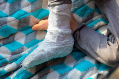 Topuk kırığında bandaj olan bir çocuk. Sağ ayak, kemik, baldır, ayak bileği, bacağı alçıda, bacağı yeni yürümeye başlamış. Mavi bir battaniyenin üzerinde uyuyan küçük boi. İnsan sağlığı ve tıp konsepti