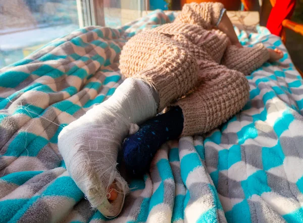 Child with bandage on leg heel fracture. Broken right foot, bone, calf, ankle, leg in plaster, splint of toddler. Little boy sleeping on a blue blanket. Human healthcare and medicine concept