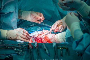 Bir jinekolog sezaryen sezaryeninden sonra rahmi tekrar birleştirir.