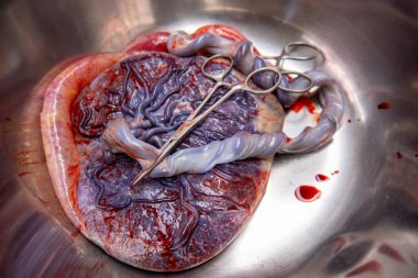 Göbek bağı olan bir plasenta, doğumdan sonra gümüş bir salin kasesinde bulunur.