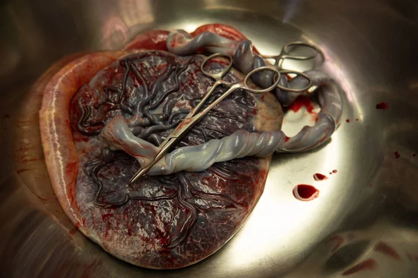 Een Placenta Met Navelstreng Zit Een Zilveren Zoute Schaal Een — Stockfoto