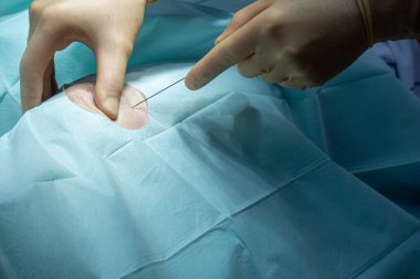 Bir doktor, bir kanül ve şırıngayla bir ameliyathanede diz delinmesi yapar.