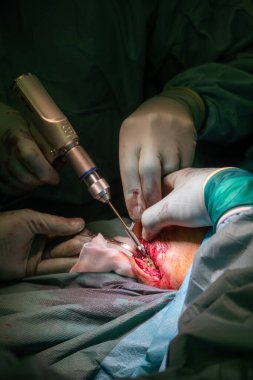 Bir ameliyatta dirsek kırığı titanyum plakalı doktorlar tarafından tedavi edilir.