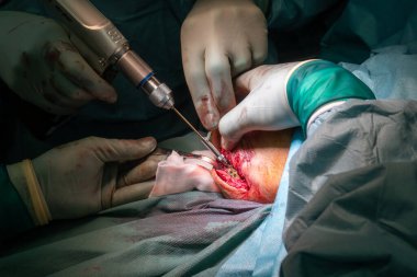 Bir ameliyatta dirsek kırığı titanyum plakalı doktorlar tarafından tedavi edilir.