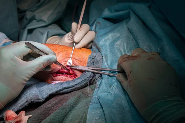 Uma Operação Uma Fratura Cotovelo Tratada Por Médicos Com Uma — Fotografia de Stock