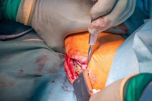 Vid Operation Armbågsfraktur Behandlas Läkare Med Titanplatta — Stockfoto