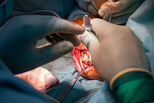 Vid Operation Armbågsfraktur Behandlas Läkare Med Titanplatta — Stockfoto