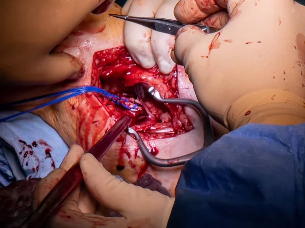Cirujano Vascular Prepara Una Arteria Pierna Para Cirugía Bypass — Foto de Stock