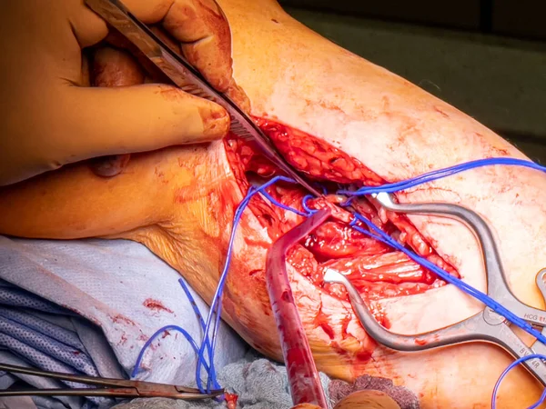 Vascular Surgeon Prepares Leg Artery Bypass Surgery — Stock Photo, Image