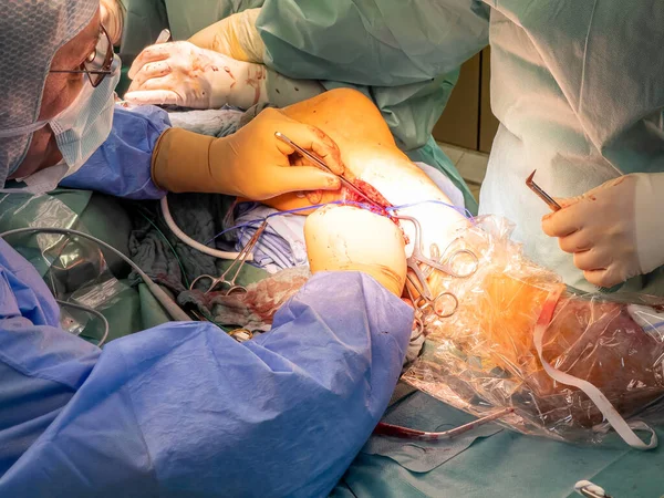 Bir Damar Cerrahı Bypass Ameliyatı Için Bacak Atardamarı Hazırlar — Stok fotoğraf