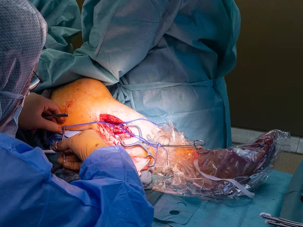 Bir Damar Cerrahı Bypass Ameliyatı Için Bacak Atardamarı Hazırlar — Stok fotoğraf