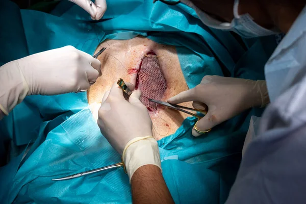 Patienten Har Delat Huden Transplanterad Buken För Att Täcka Ett — Stockfoto
